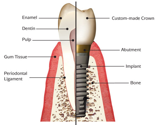 dental bone graft diagram