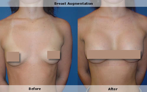 Breast augmentation, breast enlargement, small breasts 