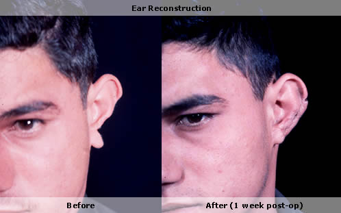 Ear reconstruction