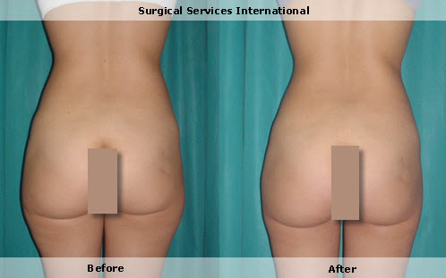 Liposuction, waist and thighs