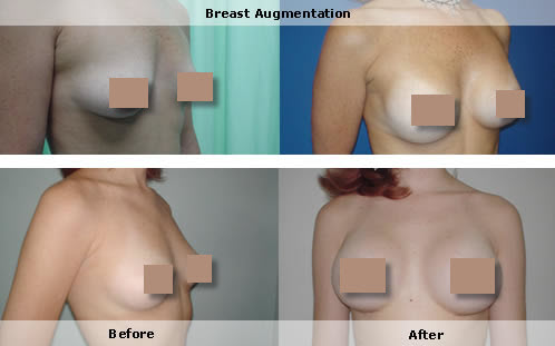 Breast augmentation medium and large 