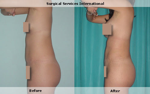 body contouring with liposculpture