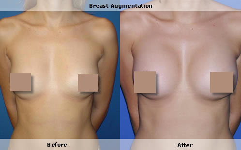 Breast augmentation, boob job