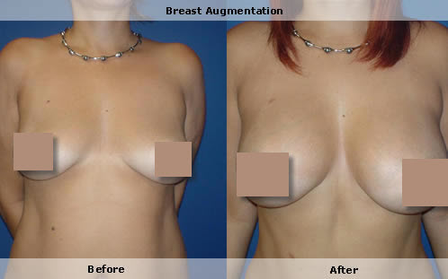 Breast augmentation, breast enlargement 