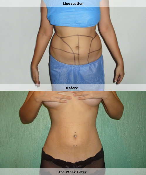 Liposuction photos