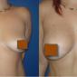 Breast Augmentation