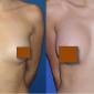 Breast Augmentation