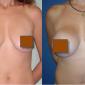 Breast Augmentation