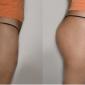 Butt Injections with PMMA, Hydrogel