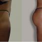 Butt Enhancement,Injections with hydrogel
