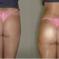 Butt Injection using PMMA