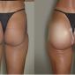 Buttocks Enhancement with hydrogel