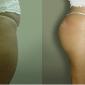 Buttocks Augmentation with hydrogel