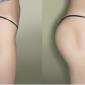 Buttocks Injections , hydrogel, PMMA