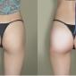 Butt Enhancement with Injections