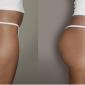 Hydrogel for Buttocks Injections