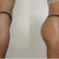 Buttocks Injections, Increased Projection in Buttocks