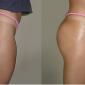 Hydrogel Buttocks Injections