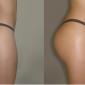 Buttocks Enhancemenst using PMMA
