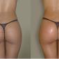 Butt Shots to Increase Butt Volume