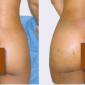 Surgical Services International provides Buttocks Injections