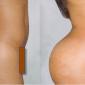 Buttocks Augmentation, using Butt Injections