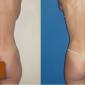 Buttocks Enhancement