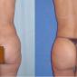 Buttocks Enhancement with Fat transfer (fat grafting)