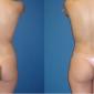 Butt augmentation, and Brazilian butt lift (Fat Grafting)