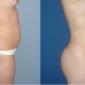 Buttocks Enhancement (augmentation)