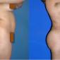 Butt Augmentation, with Brazilian butt lift