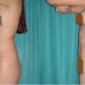 Buttocks Enhancement with harvested fat from liposuction