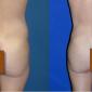 Butt augmentation using fat from your own body