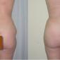 Buttocks Enhancement can be done with fat taken from your own body