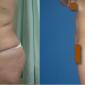 Buttocks enlargement using Brazilian butt lift