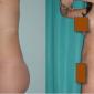 Buttocks Enlangement (augmentation) using your own fat cells