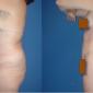 Augmentation of the buttocks using the fat harvested from your body