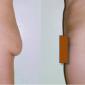 Brazilian butt lift, butt augmentation using your own fat cells