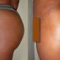 buttock_enhancement_1878181