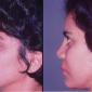 Chin Enhancement