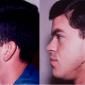 Chin Enhancement