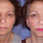 Facelift