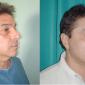 Full Facelift