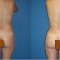 Liposuction