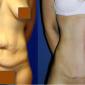 Liposuction