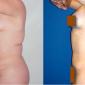 Liposuction