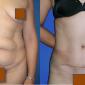 Liposuction
