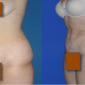 Liposuction