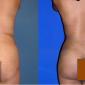Liposuction
