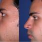 Rhinoplasty